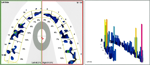 Normal occlusion on T-scan