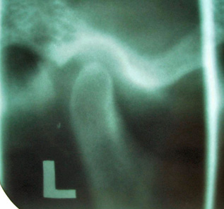 Figure 1. A healthy temporomandibular joint.