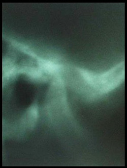 Figure 2. Posterior and superior displacement of the condyle. There is also anterior disc displacement with clicking, popping and pain.