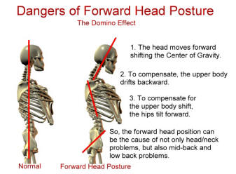 This is how your neck muscles react to forward head posture.