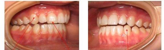 Proper cuspid guidance—the canines cause disclusion of all the other teeth in side-to-side movement—therefore no lateral stresses on the back teeth.