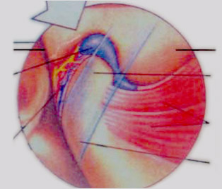 Normal TMJ with disk in place.