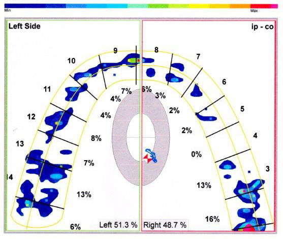 Patient’s normal closure. Hardest teeth hitting? Right side wisdom teeth.