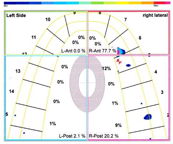 On right lateral excursion good canine guidance but with minor working side intereferences.